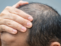 ஆண்களுக்கு சீக்கிரம் வழுக்கை விழுகிறதா? புகைபிடித்தல் உங்கள் முடியை எப்படி பாதிக்கிறது எனத் தெரியுமா? கைபிடிப்பதால் முடி உதிர்வு மற்றும் வழுக்கை ஏற்பட்ட இளைஞரின் படம்