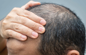 ஆண்களுக்கு சீக்கிரம் வழுக்கை விழுகிறதா? புகைபிடித்தல் உங்கள் முடியை எப்படி பாதிக்கிறது எனத் தெரியுமா? கைபிடிப்பதால் முடி உதிர்வு மற்றும் வழுக்கை ஏற்பட்ட இளைஞரின் படம்