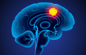 புற்றுநோய் சிகிச்சையில் புதிய புரட்சி: 5 நாட்களில் மூளைக் கட்டியை மறையச் செய்த புதிய மருந்து – விஞ்ஞானிகளின் அசத்தல் கண்டுபிடிப்பு! புற்றுநோய் செல்களை அழிக்கும் கார்ட்-டி செல் தெரபி (CAR-T Cell Therapy) மற்றும் மூளை ஸ்கேன் அறிக்கை