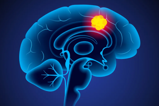 புற்றுநோய் சிகிச்சையில் புதிய புரட்சி: 5 நாட்களில் மூளைக் கட்டியை மறையச் செய்த புதிய மருந்து – விஞ்ஞானிகளின் அசத்தல் கண்டுபிடிப்பு! புற்றுநோய் செல்களை அழிக்கும் கார்ட்-டி செல் தெரபி (CAR-T Cell Therapy) மற்றும் மூளை ஸ்கேன் அறிக்கை